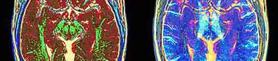 Un escaner MRI muestra las imágenes de las partes de un cerebro. (THE GUARDIAN )