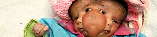 La niña india nacida con dos caras en la India.