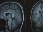 Un monitor muestra el esc&aacute;ner cerebral realizado a un paciente.