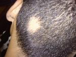 La alopecia areata