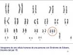 La trisom&iacute;a 18, cuando el cromosoma 18 tiene una copia de m&aacute;s, se produce el S&iacute;ndrome de Edwards.