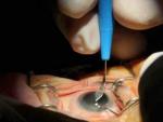 Para extraer la catarata se fragmenta &eacute;sta dentro del ojo con ultrasonidos.