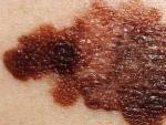 Piel de una persona afectada de melanoma.