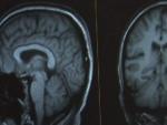 Un monitor muestra el esc&aacute;ner cerebral realizado a un paciente.