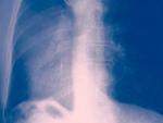 La radiograf&iacute;a muestra un pulm&oacute;n canceroso.