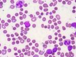 C&eacute;lulas de Leucemia linf&aacute;tica cr&oacute;nica (LLC) en una imagen de archivo.