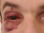 Imagen del guardia urbano herido en el ojo por un grupo de manteros en Barcelona.