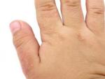 Dermatitis at&oacute;pica en la mano de un ni&ntilde;o.