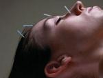 Imagen de recurso de una mujer someti&eacute;ndose a un pseudotratamiento de acupuntura.