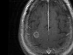 Resonancia magnética del cerebro de una mujer afectado por la ameba 'comecerebros'.