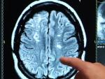 Imagen de una radiograf&iacute;a de un cerebro tras sufrir un derrame.