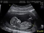 <p>Imagen de una ecografía y de un feto en el interior de un vientre materno.</p>