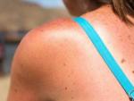 Una mujer muestra en su espalda una quemadura producida por tomar el sol.