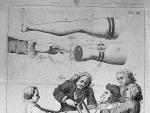 Una ilustraci&oacute;n de 1764 de una amputaci&oacute;n. Antes de la invenci&oacute;n de la anestesia, era frecuente que varios ayudantes ayudasen al cirujano sujetando al enfermo.