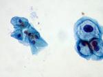 Virus del Papiloma Humano (VPH)