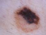 Los melanomas suelen ser asim&eacute;tricos y tener una forma irregular.