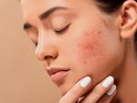 El uso de la mascarilla est&aacute; provocando brotes de acn&eacute;.