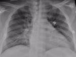 La radiograf&iacute;a de t&oacute;rax de un paciente positivo de Covid-19 que muestra una neumon&iacute;a en la parte inferior de los pulmones.