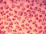 Microfotograf&iacute;a en un caso agudo de uretritis gonoc&oacute;cica, causada por la bacteria 'Neisseria gonorrhoeae'.