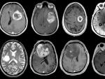 Glioblastoma, tumor cerebral agresivo mapeado en detalle gen&eacute;tico y molecular.