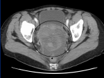 Imagen de un esc&aacute;ner de un caso de c&aacute;ncer de ovarios.