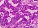 Una imagen de un adenocarcinoma.