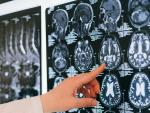 Combinan imágenes en 3D e inteligencia artificial para diagnosticar el grado de afección del Parkinson