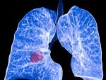 El c&aacute;ncer de pulm&oacute;n precoz hace que las c&eacute;lulas inmunitarias ayuden a los tumores a invadir los pulmones