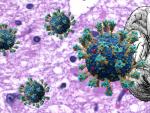 El coronavirus podr&iacute;a causar da&ntilde;os cerebrales similares a los observados en el Alzheimer.