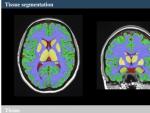 La UPV y el CNRS de Francia crean una nueva herramienta online para el estudio del cerebro