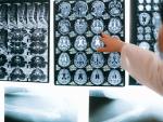 El nuevo algoritmo puede identificar los cambios cerebrales previos al Alzheimer con m&aacute;s del 99% de precisi&oacute;n.