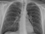 Radiograf&iacute;a tor&aacute;cica de un paciente con sarcoidosis pulmonar.