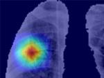 Resultados de segmentación automática de los pulmones e identificación de regiones de interés en paciente con Covid-19.