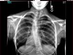 Radiografía de una joven con escoliosis