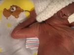 Curtis Means, el bebé prematuro más pequeño del mundo