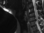 Imagen tomada por resonancia magnética de una lesión en la médula espinal de un ser humano.
