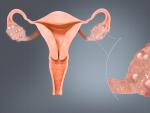 Ovarios poliqu&iacute;sticos