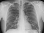 La enfermedad pulmonar obstructiva cr&oacute;nica es una afecci&oacute;n pulmonar inflamatoria cr&oacute;nica que provoca la obstrucci&oacute;n del flujo de aire de los pulmones.