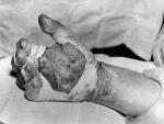 Mano de Harry K. Daghlian, fallecido por radiotoxemia por un accidente como parte del Proyecto Manhattan.