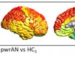 Estos mapas cerebrales muestran las regiones cerebrales con d&eacute;ficits de materia gris en la anorexia.