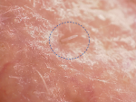 Una imagen de un &aacute;caro D. folliculorum en piel humana.