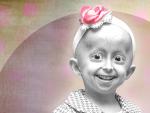 Ilustraci&oacute;n de un ni&ntilde;o con progeria.