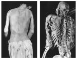 Apariencia cl&iacute;nica y esqueleto de un hombre con FOP.