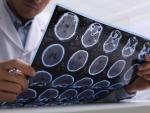 El diagnóstico por imagen es básico para ver cuánto ha sufrido el cerebro tras un ictus