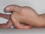 Ejemplo de articulaciones flexibles por el Síndrome de Ehlers-Danlos.