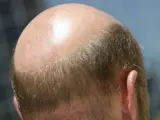 La OCU denuncia la ineficacia de los tratamientos contra la alopecia.