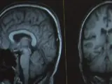 Un monitor muestra el escáner cerebral realizado a un paciente.