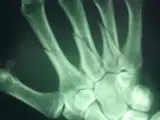 Radiografía de una fractura en el hueso metacarpiano.