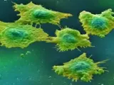 Células afectadas por cáncer de colon.
