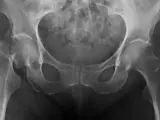 Radiograf&iacute;a de cadera.